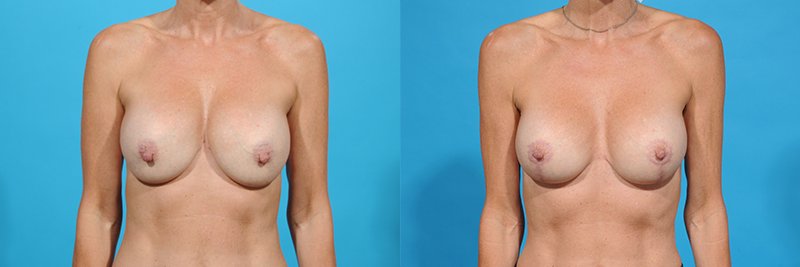 Breast Lift