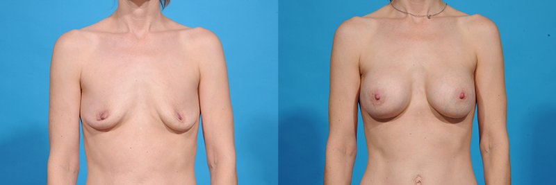 Breast Augmentation