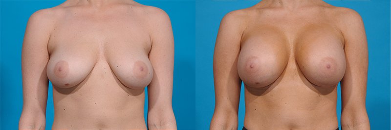 Breast Augmentation