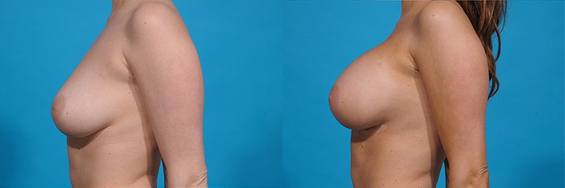 Breast Augmentation