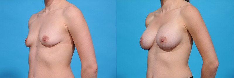 Breast Augmentation