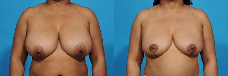 Breast Reduction