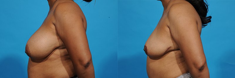 Breast Reduction