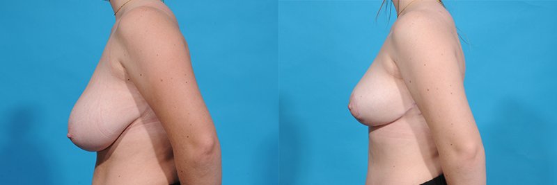 Breast Reduction