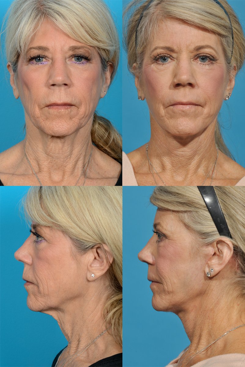 4a_4b-Facelift+Upper-Blepharoplasty